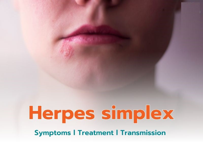 Carissa edulis Herb and Herpes Simplex Virus